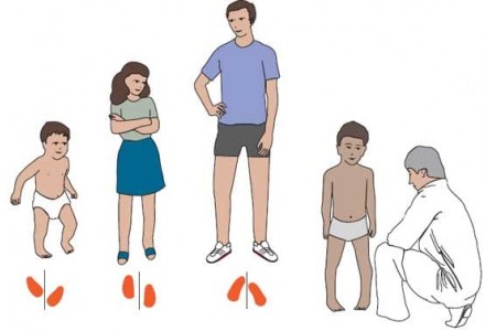 Порушення походки у дітей: причини і симптоми.